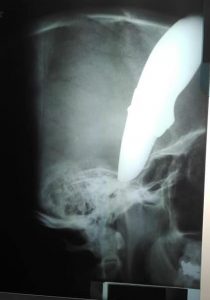 Bărbatul a fost înjunghiat cu un cuțit în cap