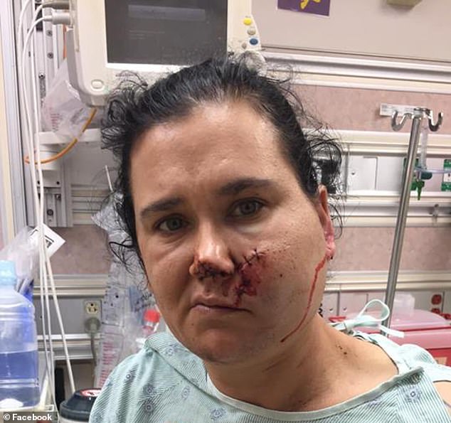 Janet Partain după ce i-a fost scoasă săgeata