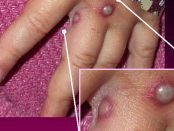 Variola maimutei ar putea suferi o mutatie care sa declanseze o epidemie letala