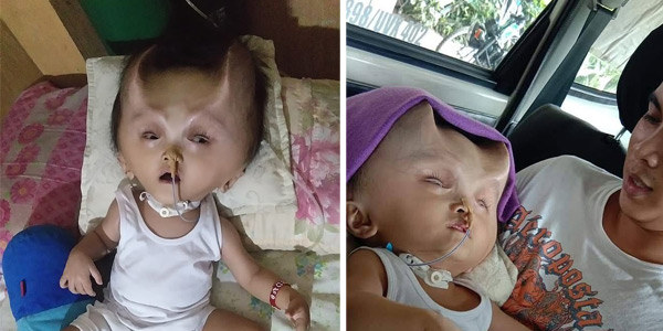 Băiatul cu coarne de diavol născut cu o afecțiune congenitală gravă