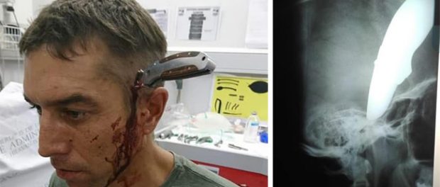 Barbat injunghiat in cap Africa de Sud Bărbat înjunghiat în cap în Africa de Sud