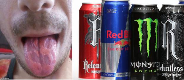 Un profesor susține că băuturile energizante i-au mâncat limba