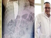 A stat o SĂPTĂMÂNĂ cu o macetă înfiptă în spate după ce soțul a înjunghiat-o