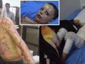 Copii kurzi arși cu NAPALM de către armata turcă a președintelui Erdogan