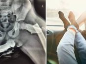 Radiografie șocantă! Arată șoldurile unei tinere femei zdrobite într-un accident