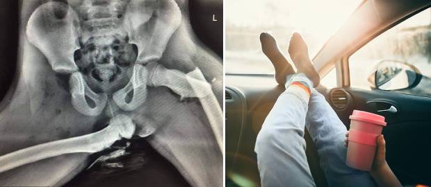 Radiografie șocantă! Arată șoldurile unei tinere femei zdrobite într-un accident