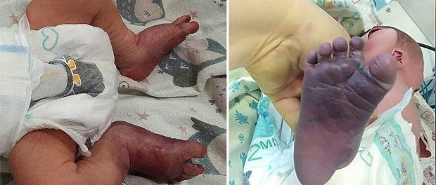 Unui bebelușul i-au fost rupte picioarele în timpul nașterii