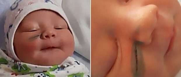 O nou-născută a fost tăiată pe față în timpul unei operații de cezariană